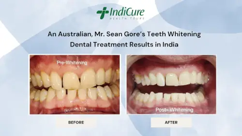 Mr. Sean Gore's Teeth Whitening Dental Treatment Results